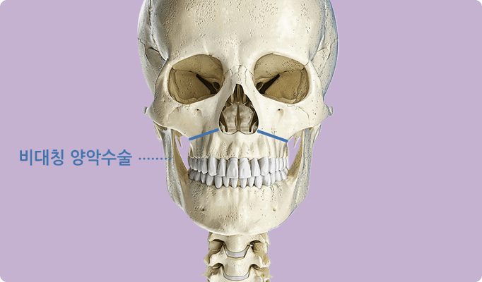 2in1 페이스 기술 / 비대칭 / 경조직(뼈)