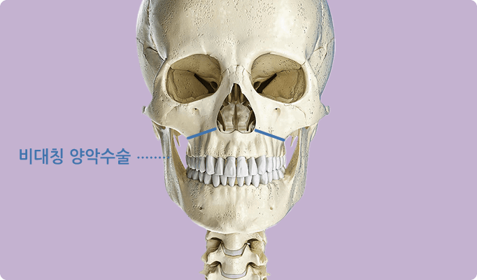 2 in 1 페이스 기술 / 비대칭 / 경조직(뼈)