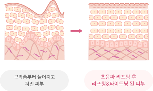 비절개리프팅 이미지