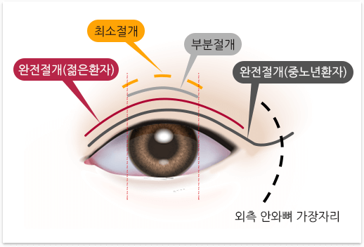 부분 절개