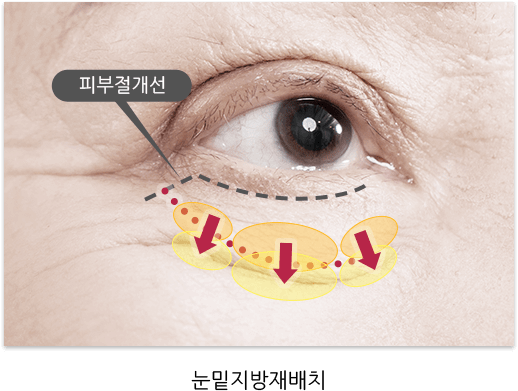 눈밑지방재배치