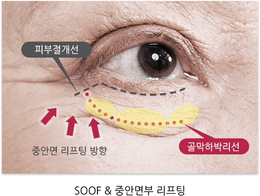 SOOF&중안면부 리프팅