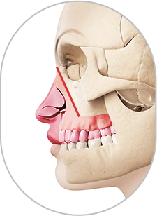 코를 포함하는 양악수술