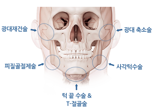 안면윤곽수술 이미지