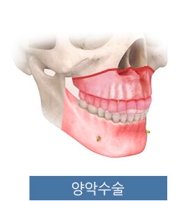 양악수술