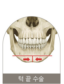 턱 끝 수술