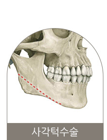 사각턱수술