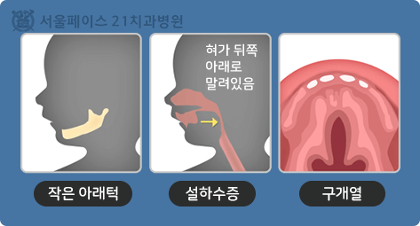 피에르-로빈 증후군